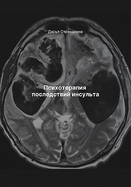 Стрекалина Дарья - Психотерапия последствий инсульта